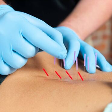 Dry Needling