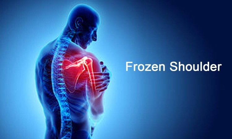 Frozen Shoulder: Why Early Treatment is Crucial
